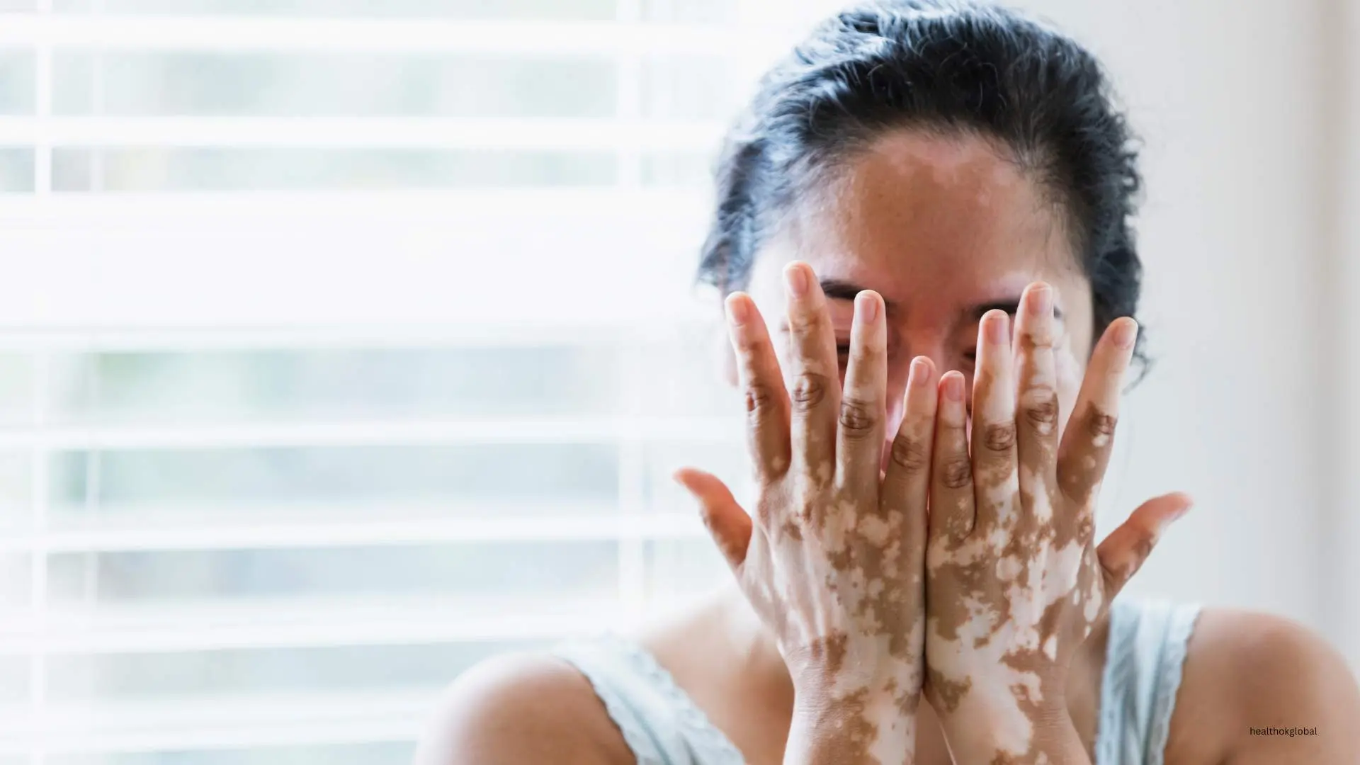 Ayurvedic Remedies for Vitiligo: Natural Treatments for Skin Health