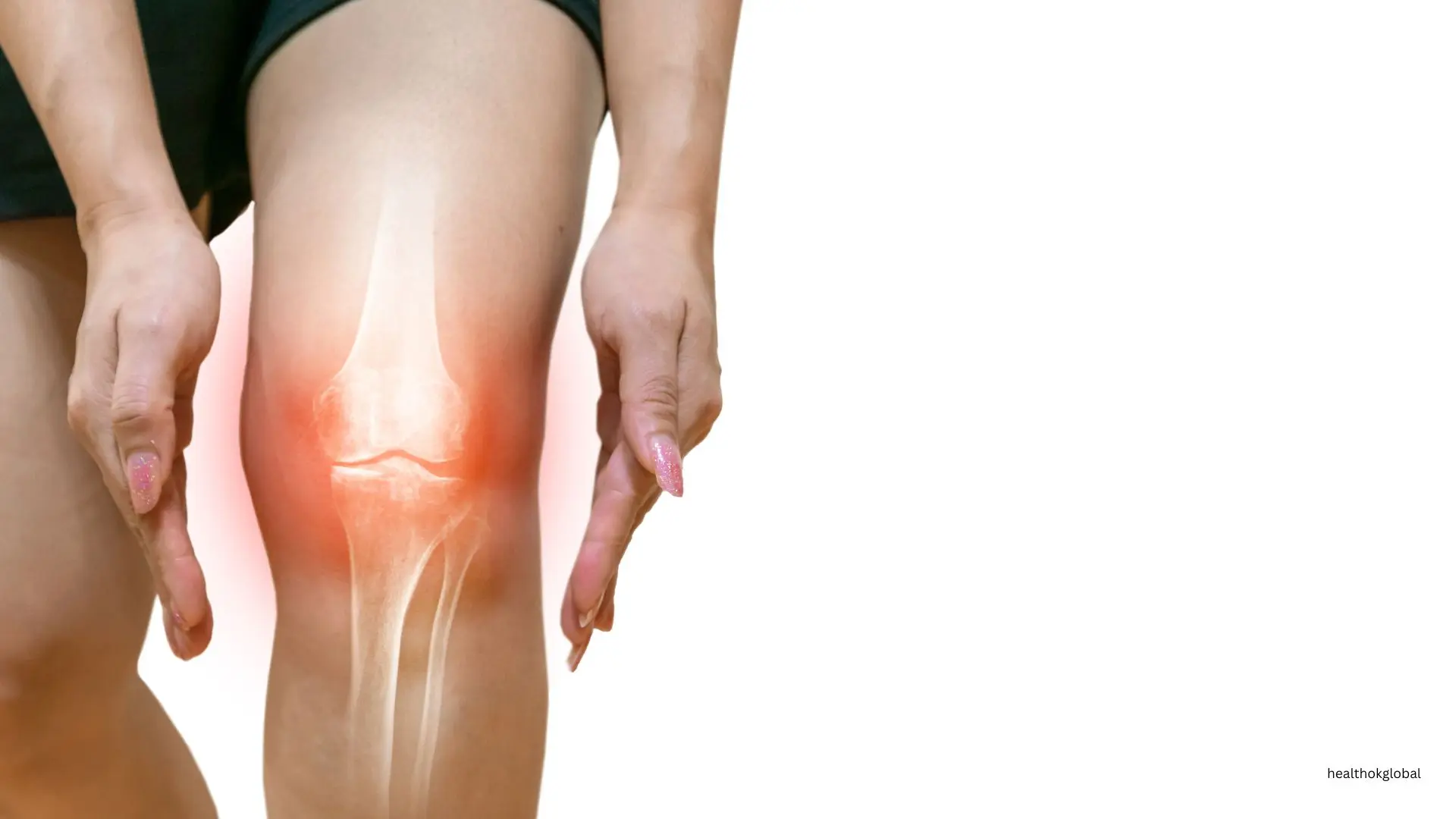 Bone Tuberculosis: Comprehensive Guide