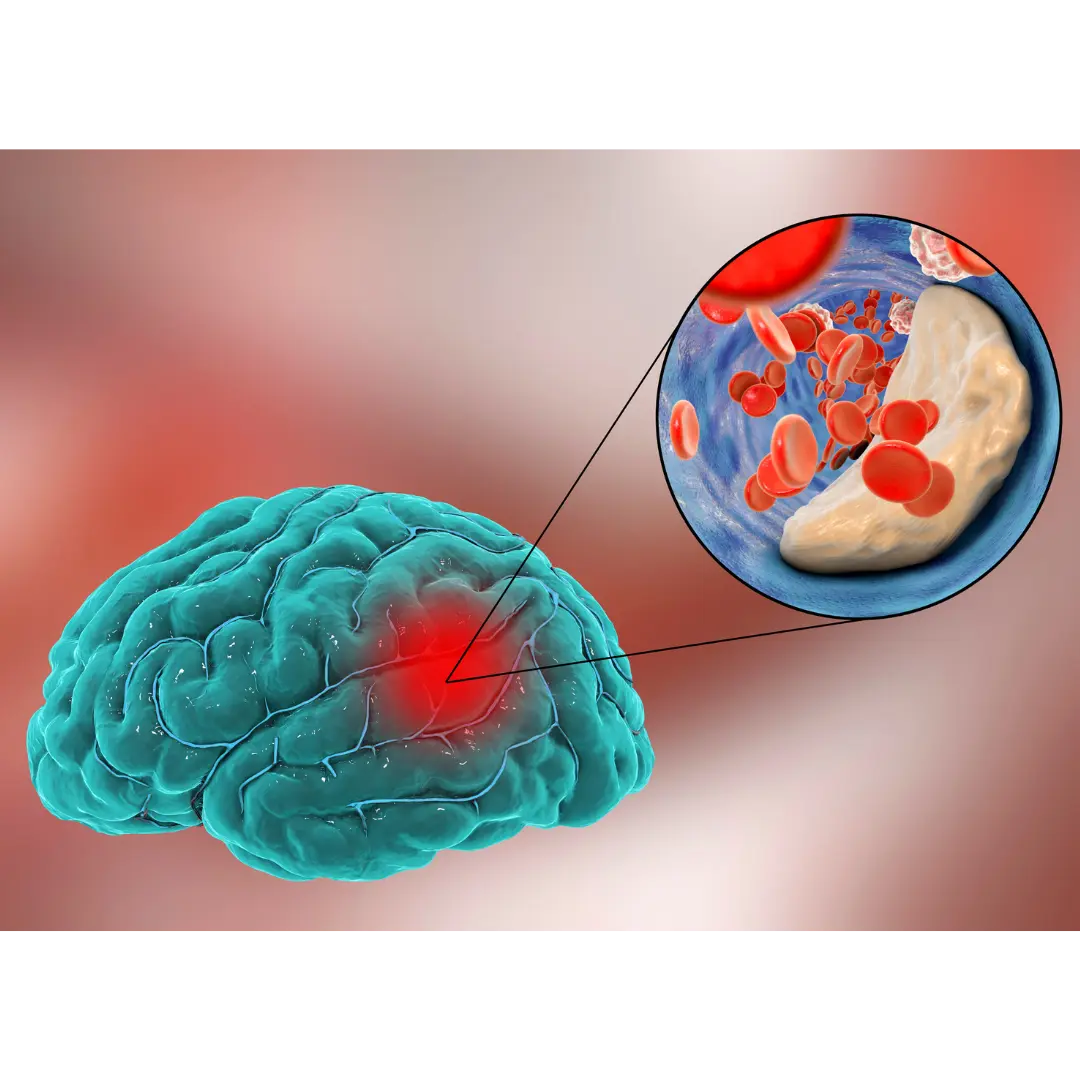 Brain Clot Treatment and Recovery: Proven Methods with Case Studies