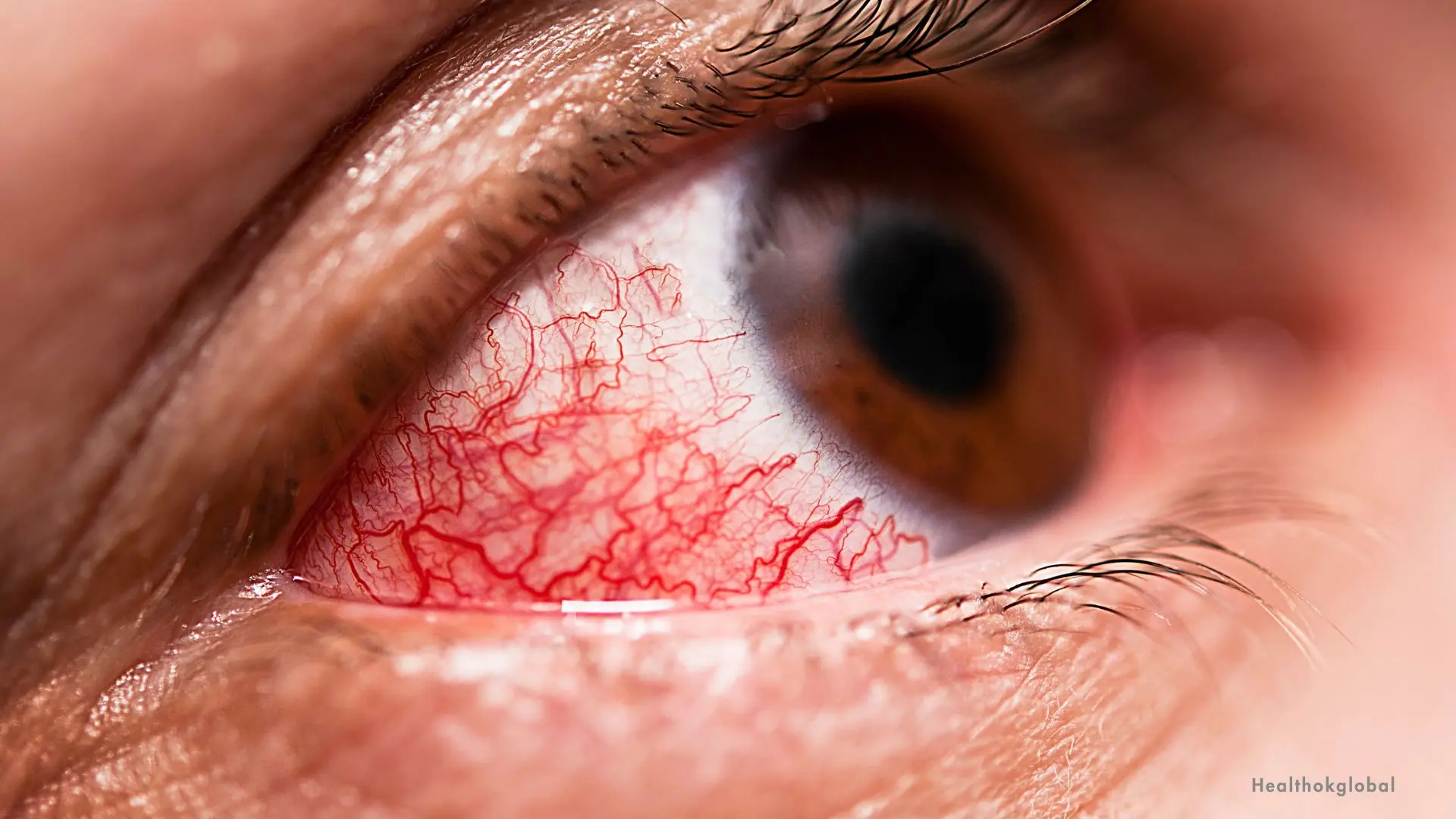 Conjunctivitis (Eye Flu): A Detailed Guide