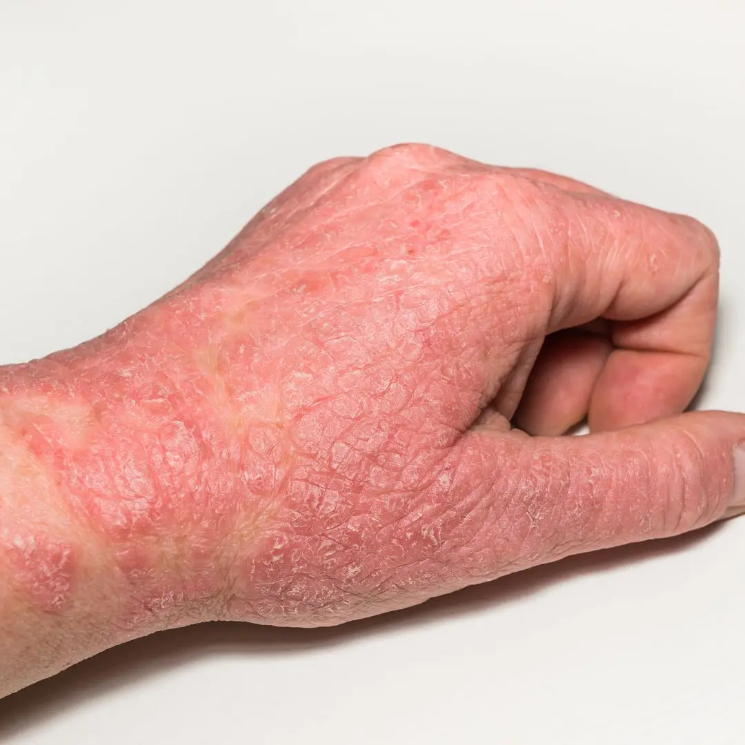 Cystic Lesion: Understanding Causes, Symptoms, and Treatment
