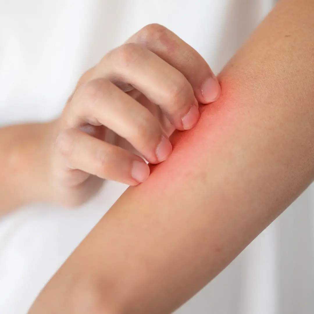 Kidney Disease Itching: Causes, Symptoms, and Treatment