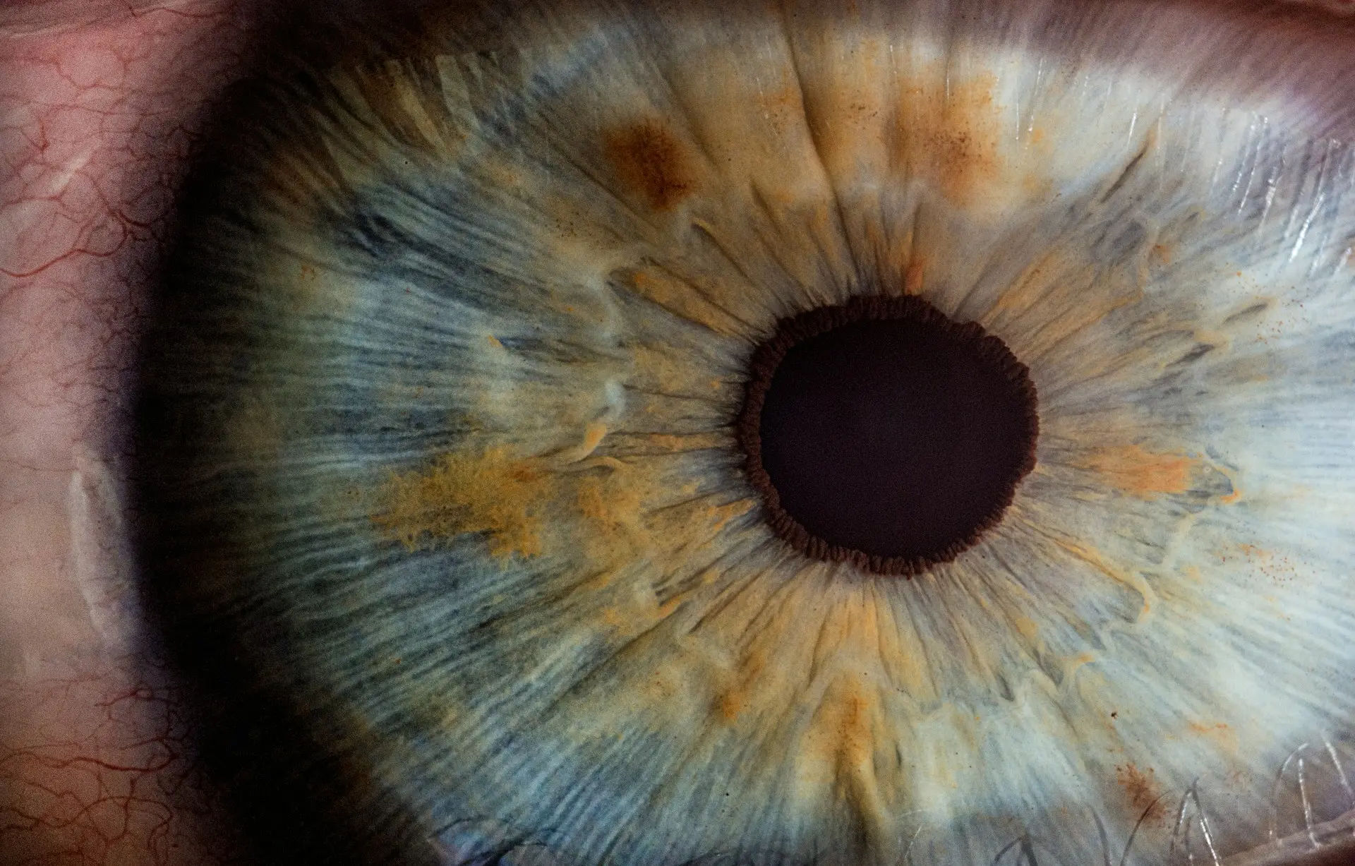 Morgagnian Cataract: A Comprehensive Guide
