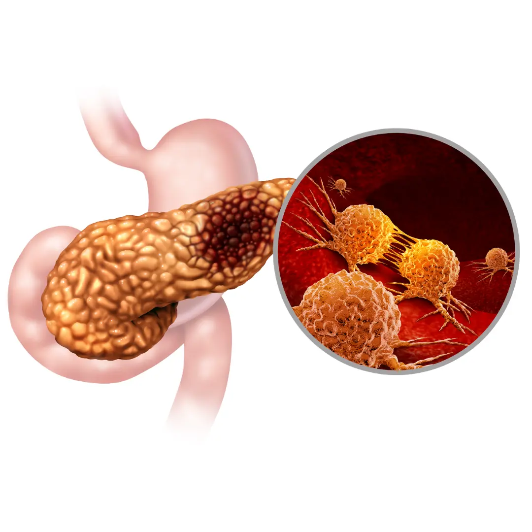 Recognizing Signs of Pancreatitis at Home: A Preliminary Guide