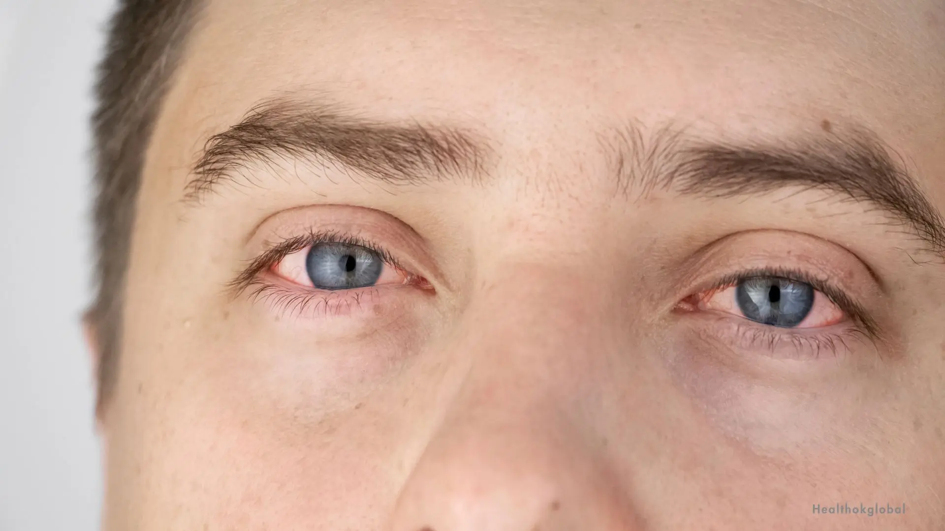 Understanding Eye Flu Causes: A Comprehensive Guide