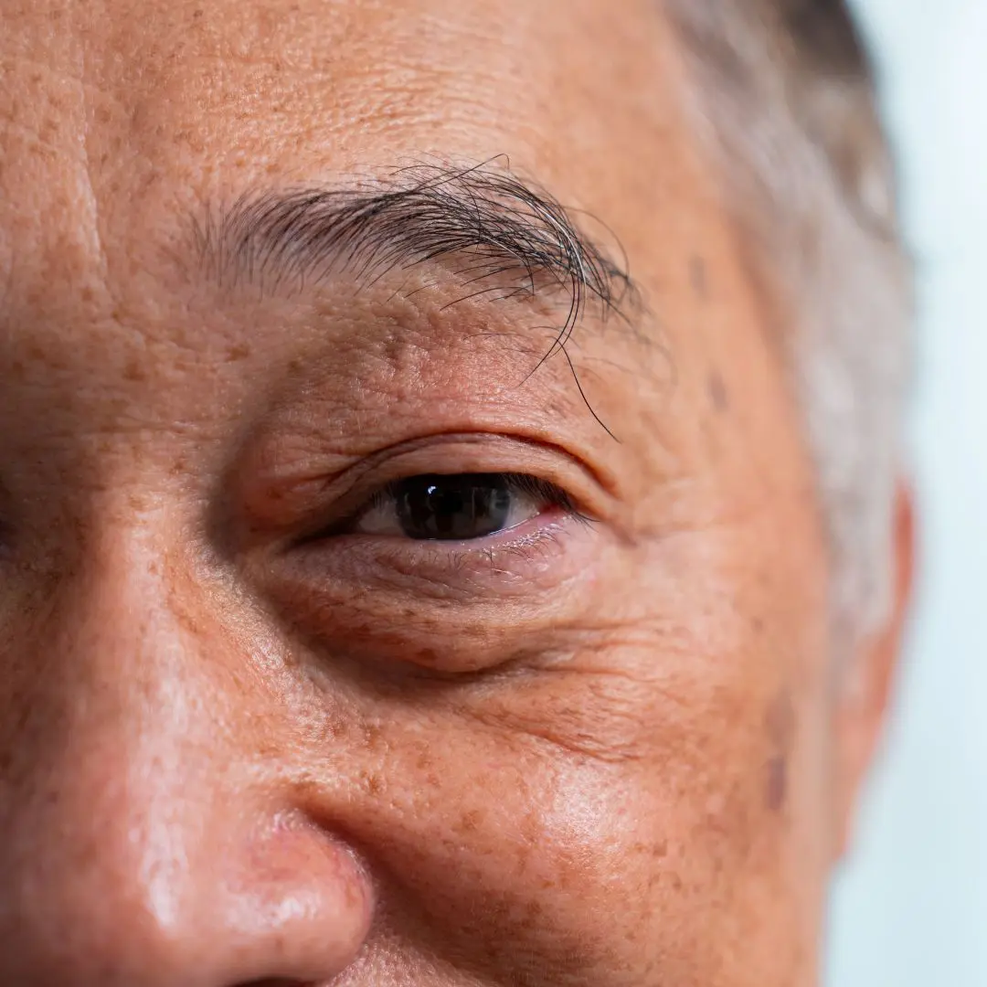 Understanding Posterior Subcapsular Cataract: Causes, Symptoms, and Treatment