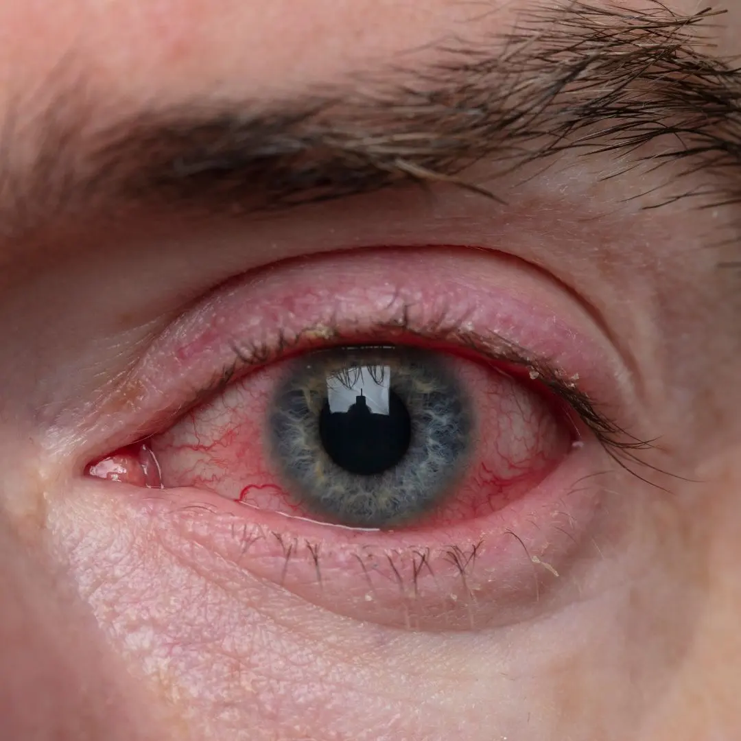Understanding Sore Eyes: Causes, Symptoms, and Treatment