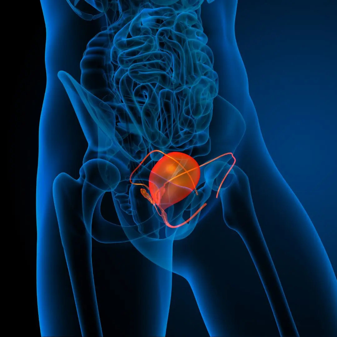 Understanding Trabeculated Bladder: Causes & Treatment Options