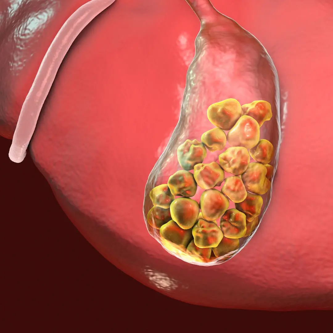 Cystic Duct