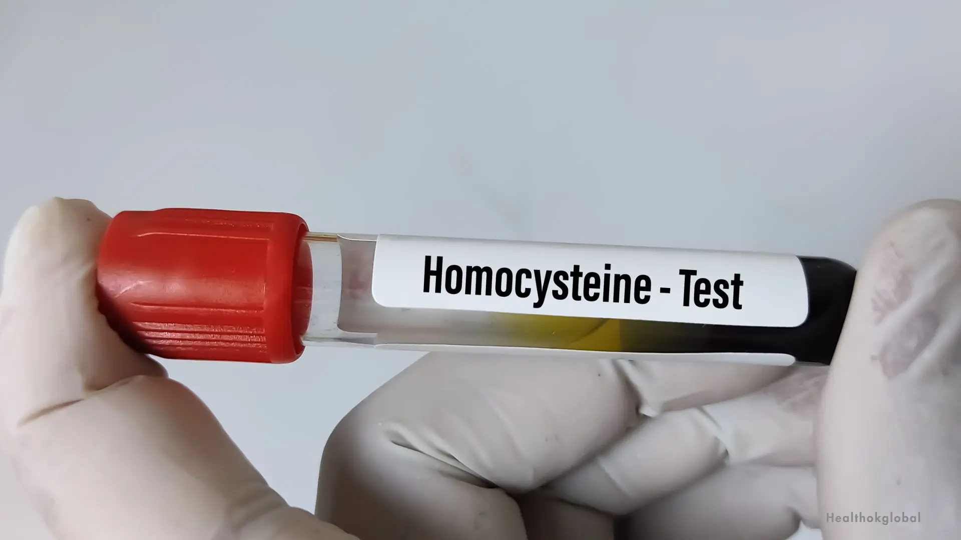 homocysteine test