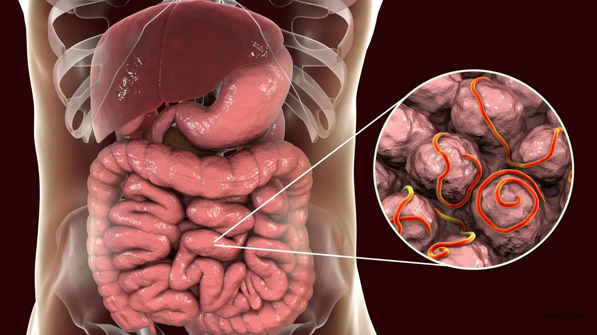 Intestinal Tuberculosis