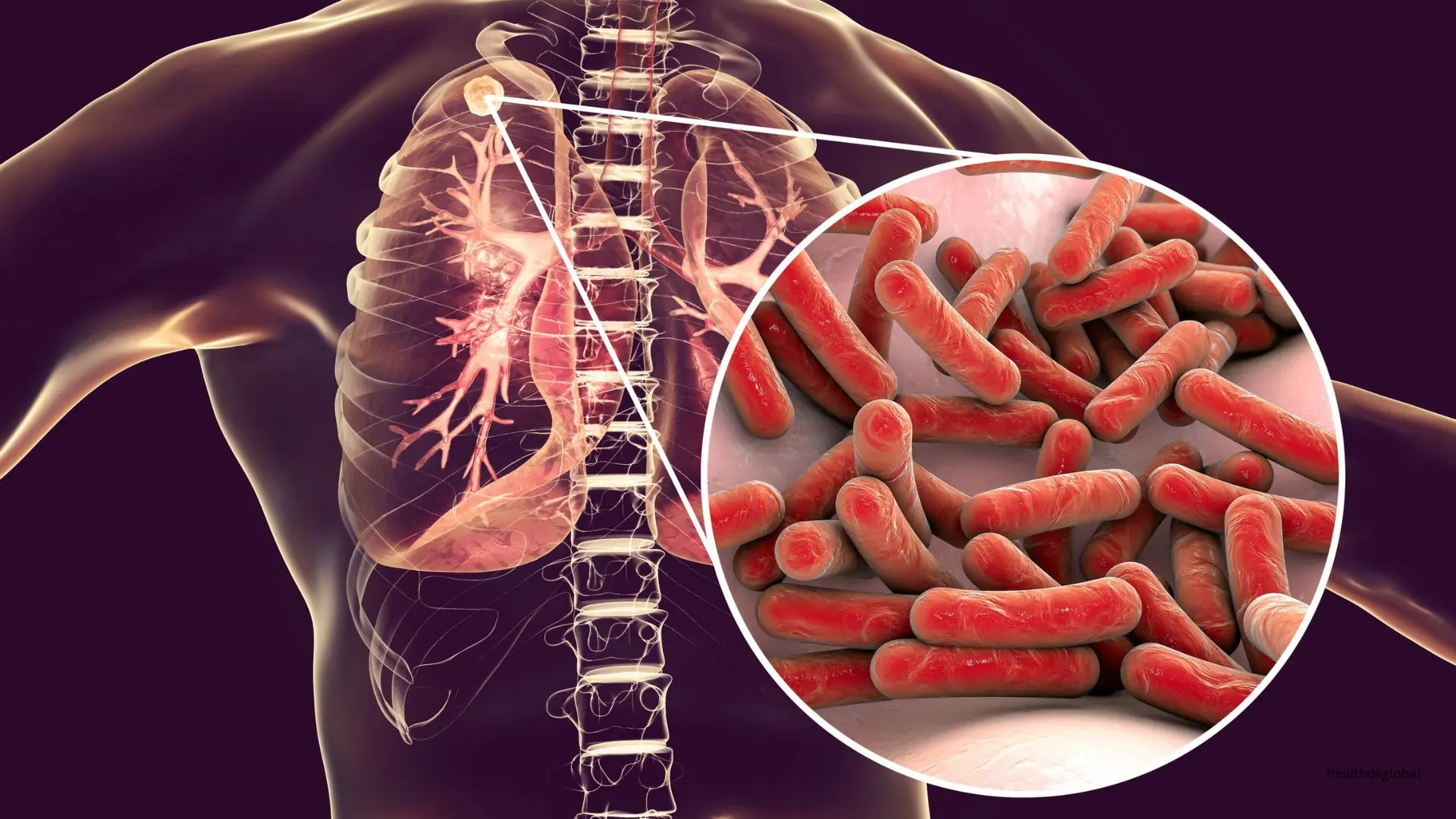 Pathogenesis of Tuberculosis