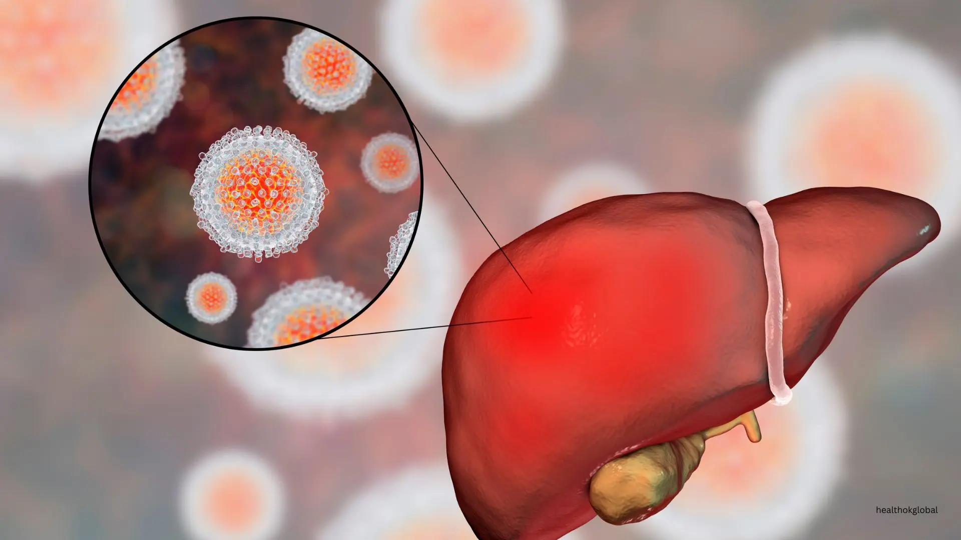 Hepatitis B Post Exposure Prophylaxis