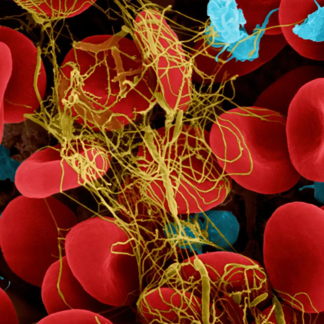 Close-up view of a blood clot forming among red blood cells, showcasing the fibrin network responsible for clotting, associated with conditions like brain clots and ischemic strokes.