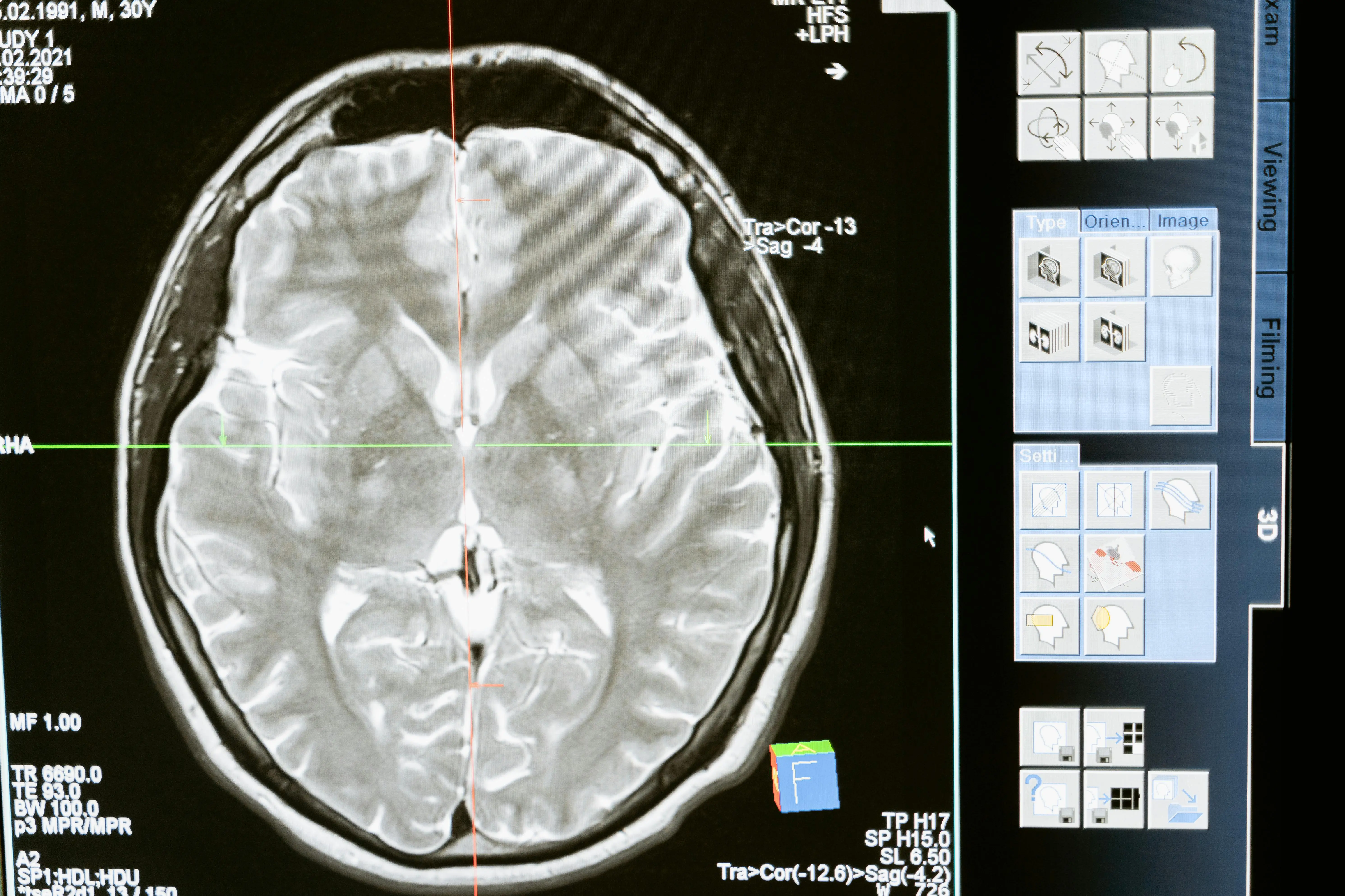 MRI scan of the human brain highlighting areas affected by neurological disorders in elders, used for diagnostic and treatment planning purposes.