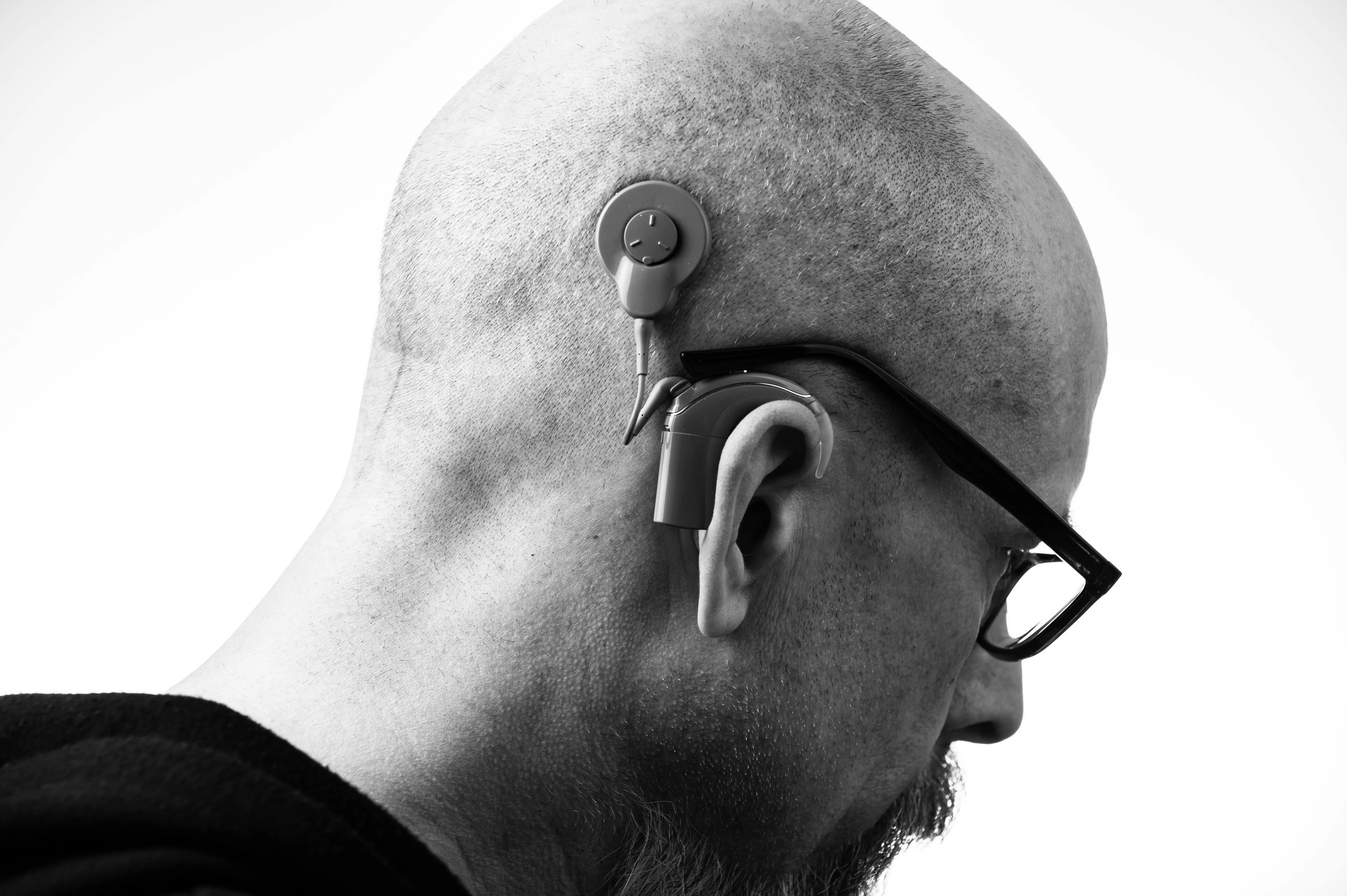 Close-up of a man wearing a cochlear implant and glasses, showcasing advanced hearing aid technology for individuals with severe hearing loss.