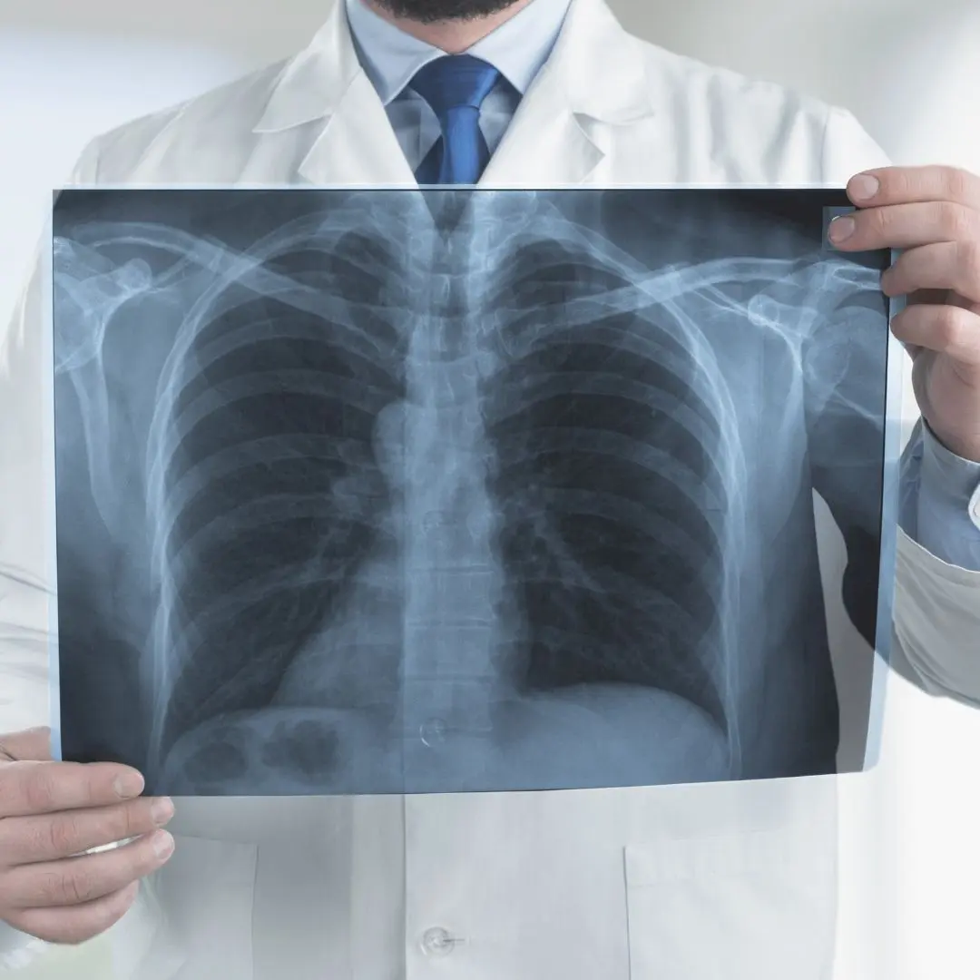 Doctor holding a chest X-ray to examine lung health, commonly affected in conditions like cystic fibrosis and other respiratory disorders.