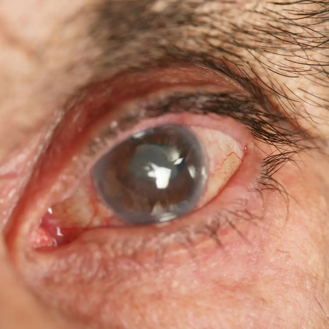 Nuclear Cataract Eye Condition