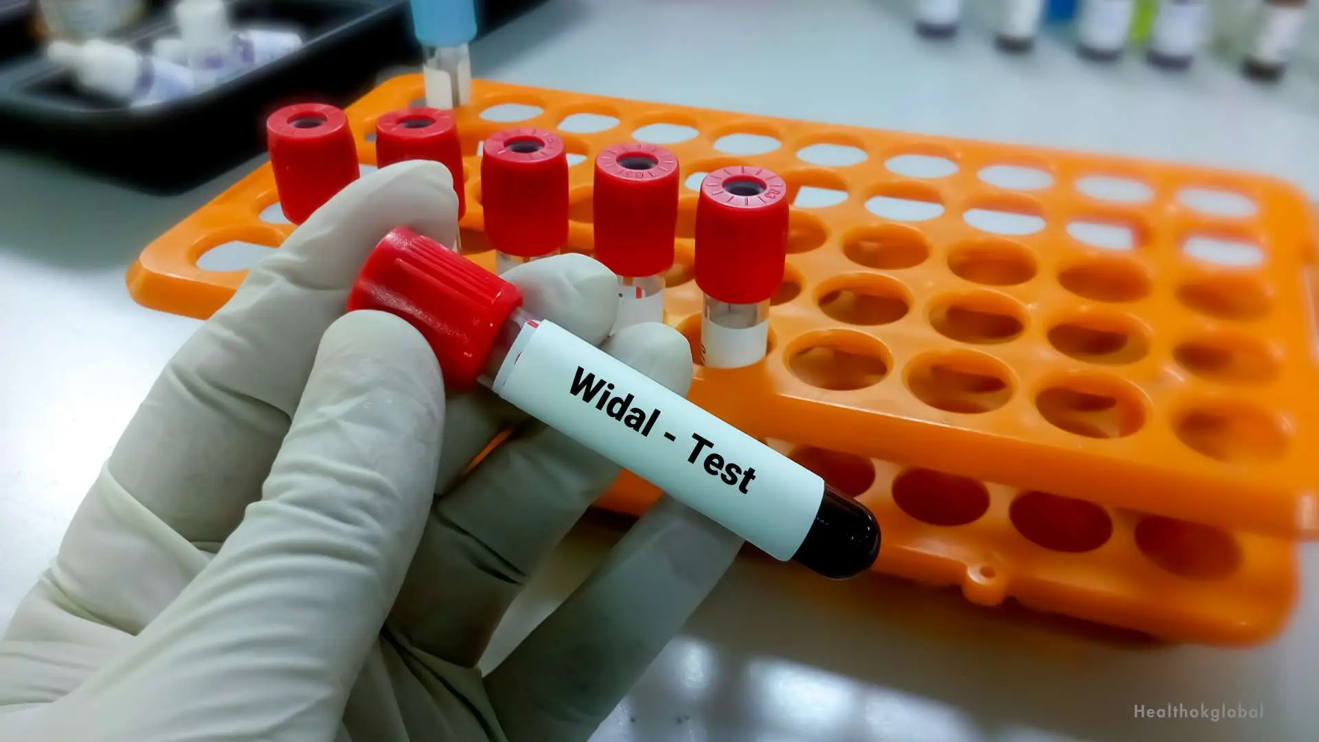 Positive Widal test result for typhoid fever